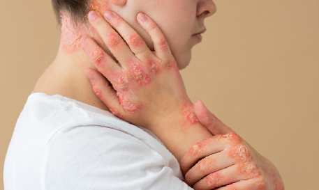 Dark Circles & Stretch Marks